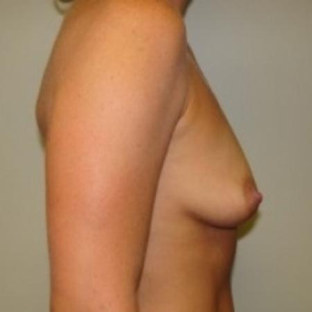 Before image 4 Case #79736 - Breast Augmentation