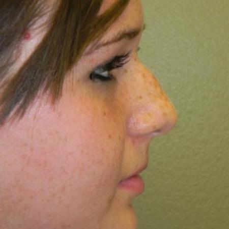 Before image 2 Case #81886 - Closed Rhinoplasty