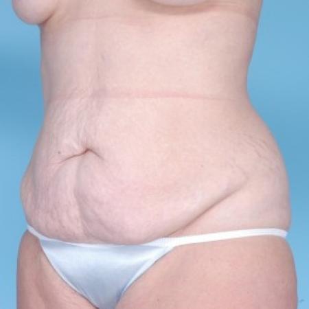Before image 2 Case #82246 - Liposuction