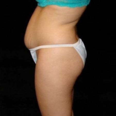 Before image 3 Case #80331 - Buttocks Augmentation Via Fat Grafting with Liposuction of Abdomen, Waist, Flanks, Dorsal Roll, Inner and Outer Thighs