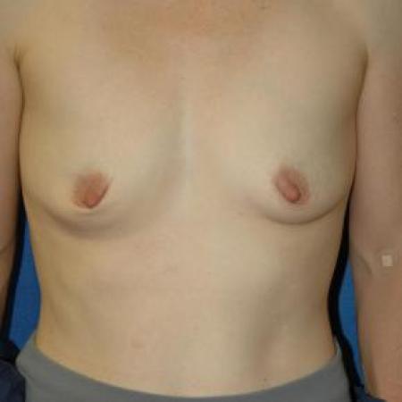 Before image 1 Case #80886 - Breast Augmentation 