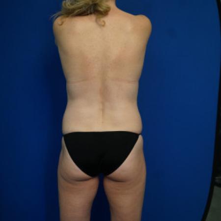 Before image 5 Case #88366 - 46 year old female after Mommy Makeover