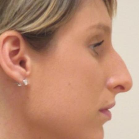 Before image 2 Case #82791 - Septorhinoplasty