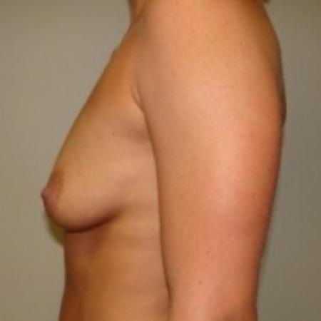 Before image 5 Case #79736 - Breast Augmentation