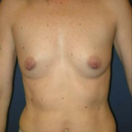 Before image 1 Case #82886 - Breast Augmentation using Memory Shape Gel Implants