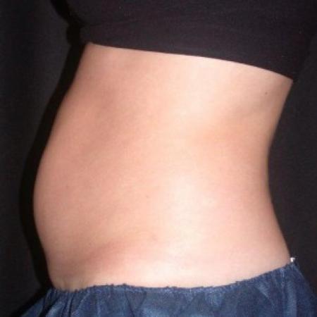 Before image 2 Case #81856 - CoolSculpting