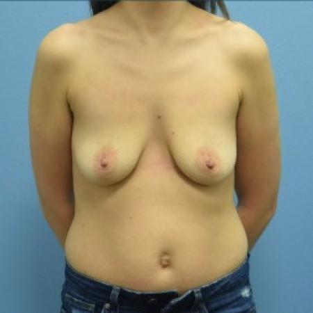 Before image 1 Case #86151 - Breast Augmentation with Silicone Implants