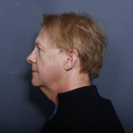 Before image 2 Case #83681 - 63 Year Old Male