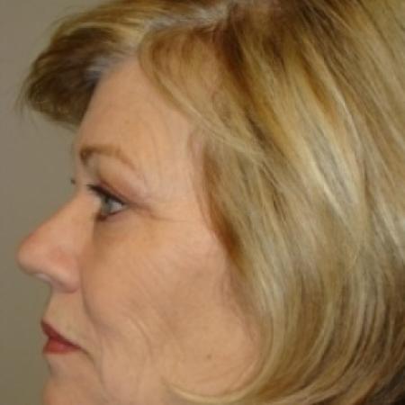 Before image 4 Case #79056 - Facelift