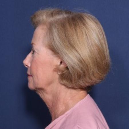 Before image 2 Case #83836 - 69 Year Old Female