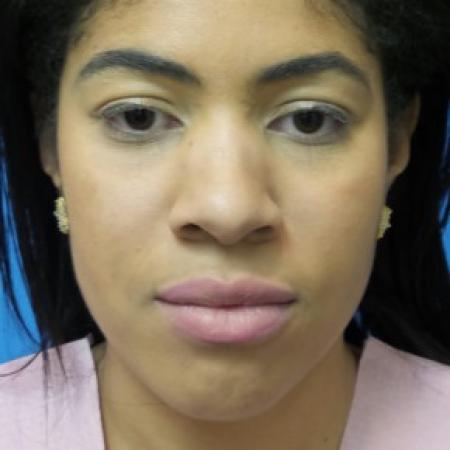 Before image 1 Case #86446 - Rhinoplasty - 3 months post-op