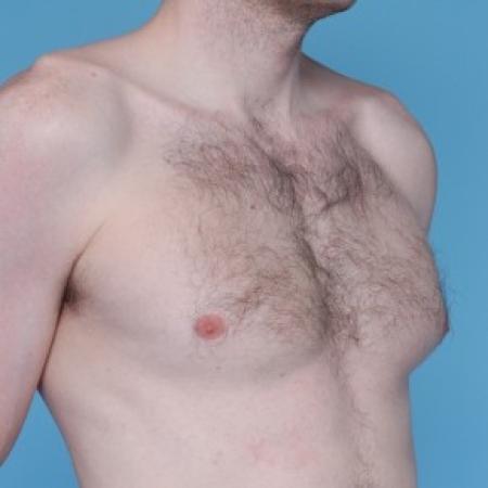 Before image 2 Case #82256 - Liposuction