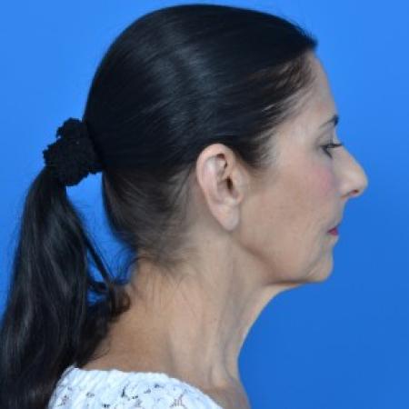 Before image 3 Case #88061 - Facelift and Neck Lift