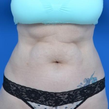 Before image 1 Case #87866 - Tummy Tuck