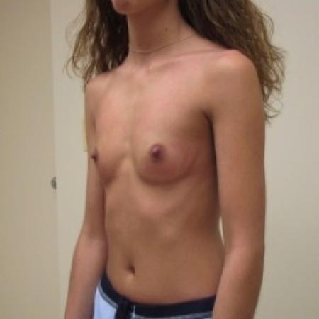 Before image 3 Case #81236 - Bilateral breast augmentation with saline filled implants 