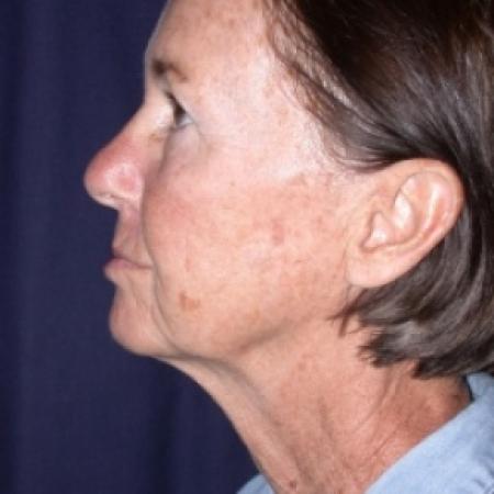 Before image 3 Case #78811 - FaceLift- Minimal Access Cranial Suspension (MACS)/ Fat Grafting 