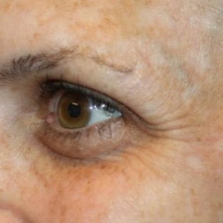 Before image 2 Case #83891 - Botox (Crows Feet Only) - 34 year old female.