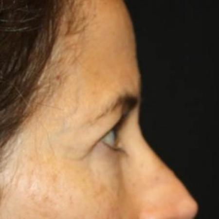 Before image 3 Case #84886 - Upper LidBlepharoplasty & Brow Lift - 50 year old female
