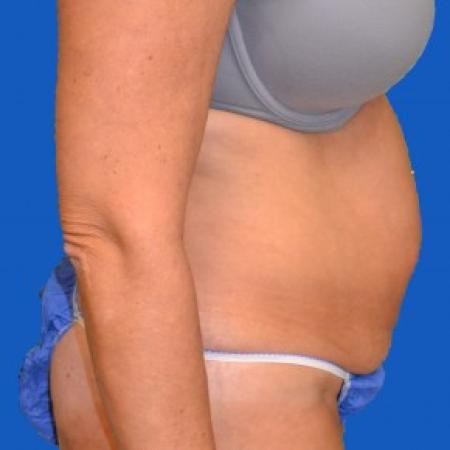 Before image 2 Case #87841 - Tummy Tuck