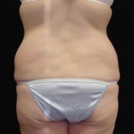 Before image 6 Case #80226 - Circumfrential Abdominoplasty with Liposuction of Abdomen, Waist, and Flanks