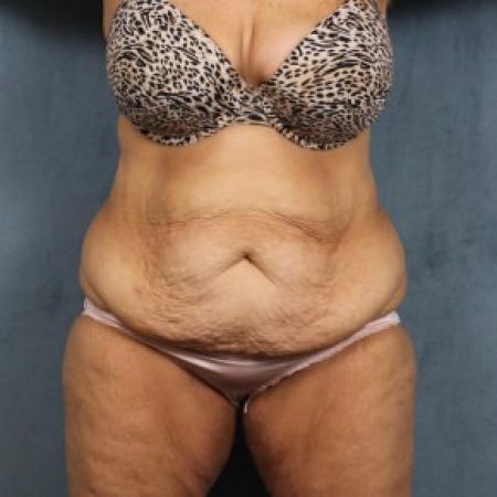 Before image 1 Case #82551 - extended abdominoplasty (tummy tuck) after massive weight loss