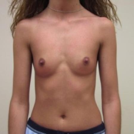 Before image 1 Case #81236 - Bilateral breast augmentation with saline filled implants 
