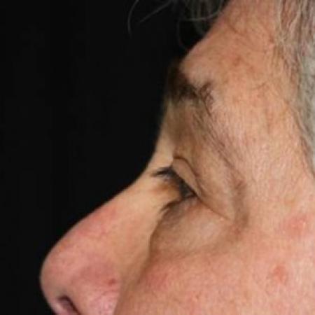 Before image 3 Case #83461 - Blepharoplasty - 61 year old male.