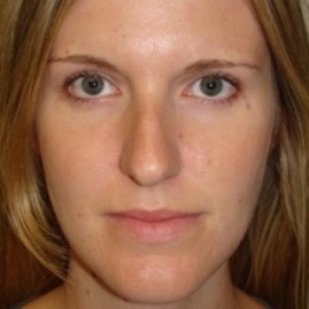Before image 1 Case #79551 - Rhinoplasty