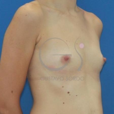 Before image 2 Case #87636 - Anatomical breast augmentation