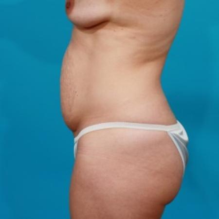 Before image 3 Case #84106 - Abdominoplasty with Flank Lipo