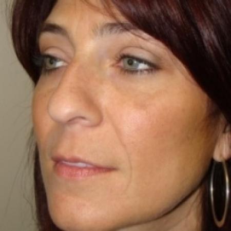Before image 2 Case #79556 - Rhinoplasty