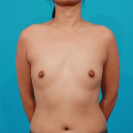 Before image 1 Case #79601 - Silicone Breast Augmentation
