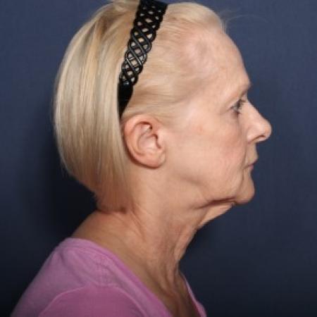 Before image 2 Case #84356 - 67 Years Old Female