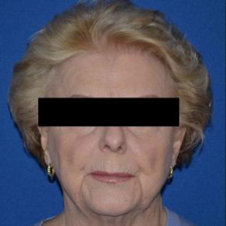 Before image 1 Case #86796 - Full Facelift