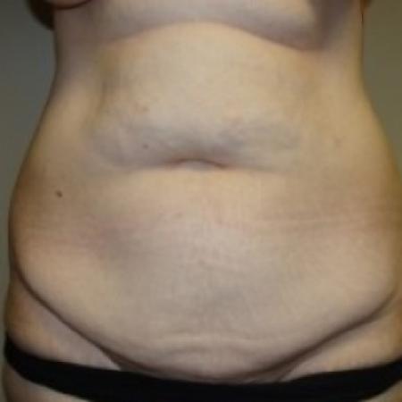 Before image 1 Case #79486 - Tummy Tuck
