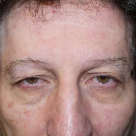 Before image 1 Case #82446 - Blepharoplasty
