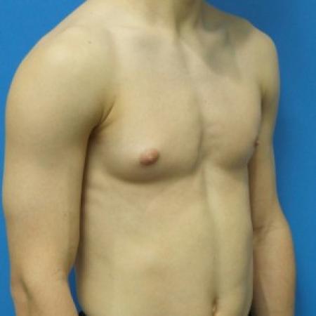 Before image 2 Case #87306 - 17-year old  -  Excisional Gynecomastia right breast