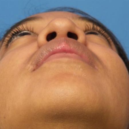 Before image 4 Case #86471 - Rhinoplasty/Septoplasty/Turbinectomy - 1 year post-op