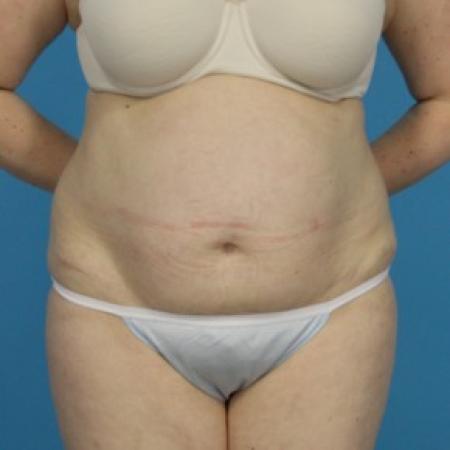 Before image 1 Case #84076 - Abdominoplasty with Flank Lipo