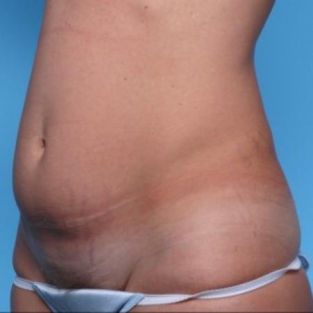 Before image 2 Case #82296 - Abdominoplasty 