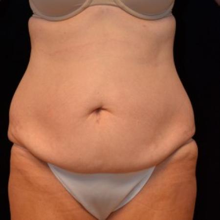 Before image 1 Case #81721 - Tummy Tuck