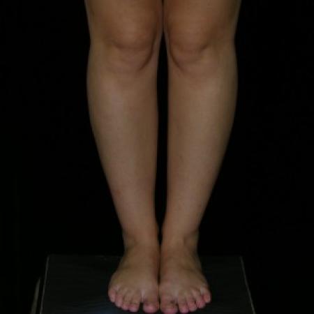 Before image 1 Case #81936 - Calf and Ankle Liposculpture