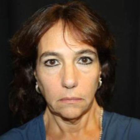 Before image 1 Case #85061 - Facelift and Neck Lift - 58 year old female