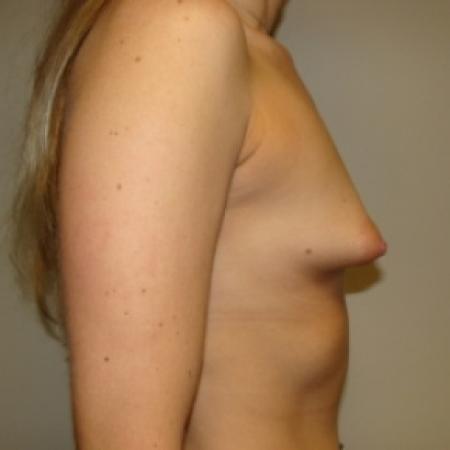 Before image 3 Case #80021 - Breast Augmentation