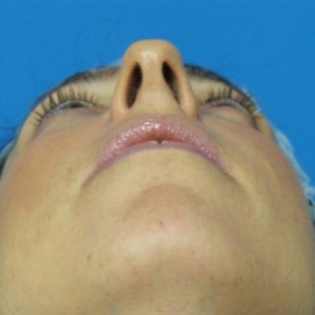 Before image 4 Case #86856 - 40 year old woman treated with Nose Surgery/Septoplasty/Turbinectomy