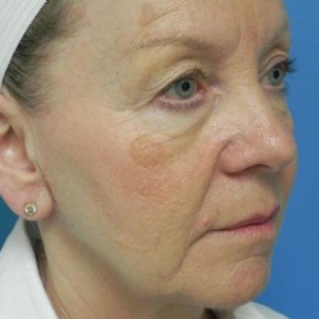 Before image 2 Case #86616 - Facelift/Upper & Lower Blepharoplasty/Laser Resurfacing to Full Face/Juvederm      7 months post-op