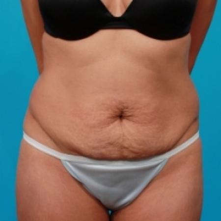 Before image 1 Case #78861 - Extended Abdominoplasty