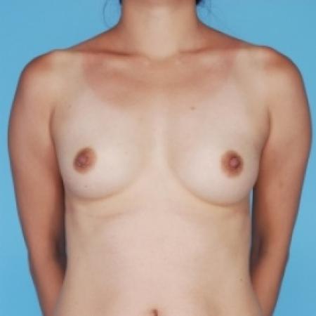 Before image 1 Case #79661 - Breast Augmentation 
