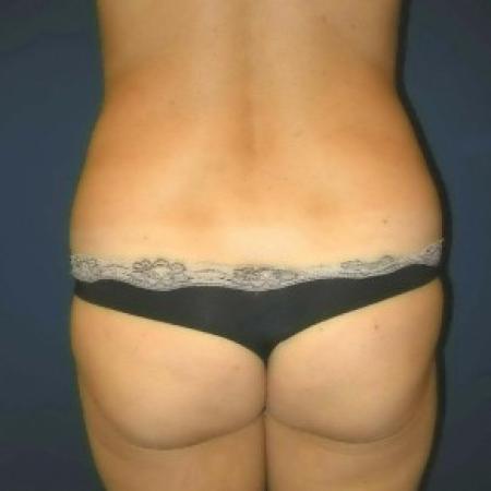 Before image 3 Case #82821 - Tummy Tuck and Liposuction of Hips
