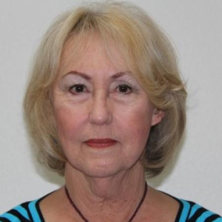 Before image 1 Case #84626 - Lower facelift, necklift and browlift with SMAS grafting to Nasolabial folds